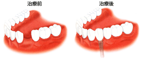 インプラント治療例