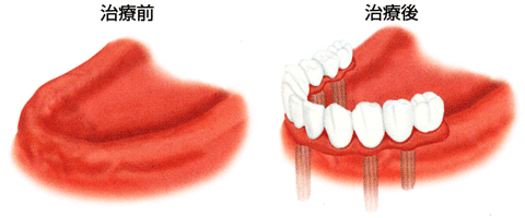 インプラント治療例３
