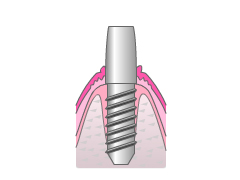 インプラント模式図２