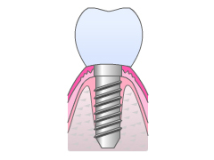 インプラント模式図３